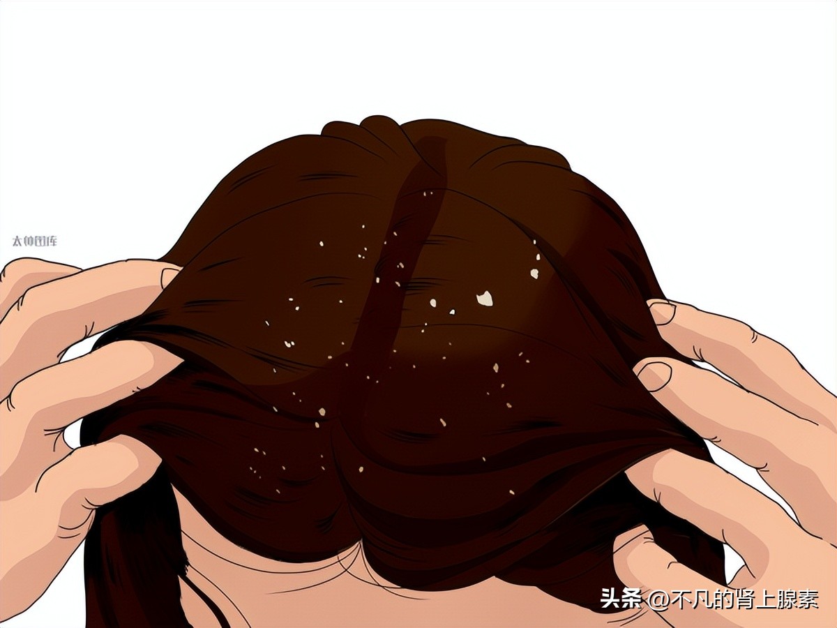 头屑是什么原因造成的如何解决,长头屑有什么方法才能去头屑