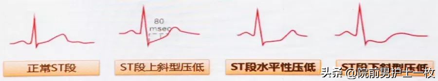 关于心绞痛护理措施的图片,冠心病心绞痛救治成功率