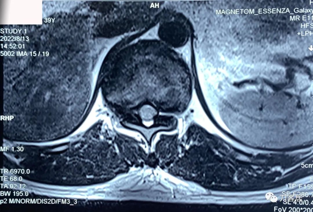 良性单侧下肢肌萎缩,下肢肌肉萎缩24年能治好吗