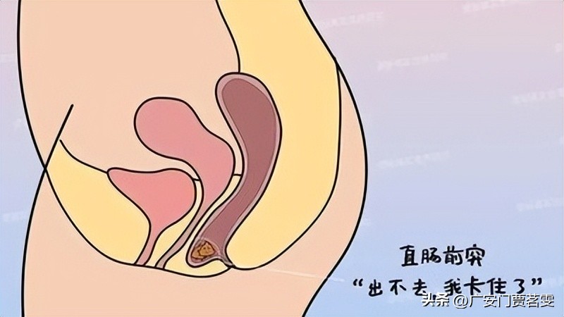 解析直肠前突的治疗方法,直肠前突是什么意思啊