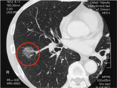 左肺上叶8*5mm磨玻璃结节最坏结果,发现肺磨玻璃小结节怎么办