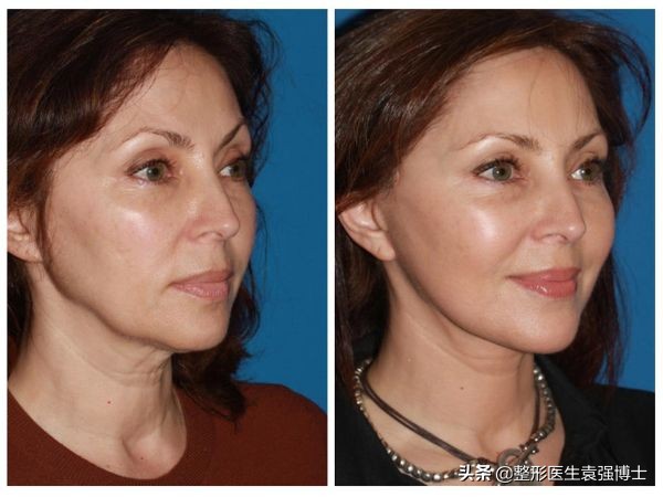 拉皮手术费,小拉皮手术费多少钱