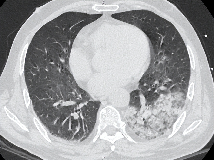 发热十多天了输液吃药还是发热,脓毒症高烧不退