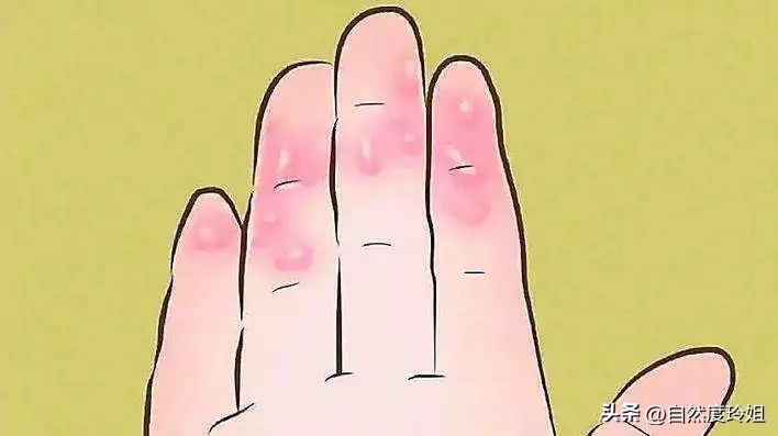 夏天手脚起小水泡严重脱皮,手脚长痒痒的小水泡