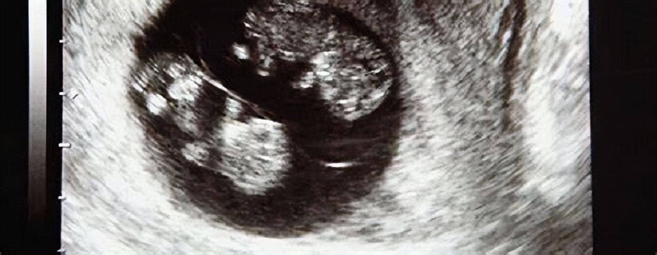 美国产妇水下分娩生下双胞胎,美国孕妇水下分娩双胞胎完整版