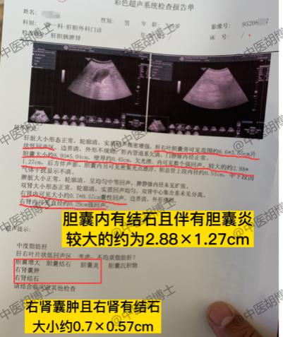 胡博士治疗病案分享：胆囊结石伴肾结石、一个半月验方效果明显