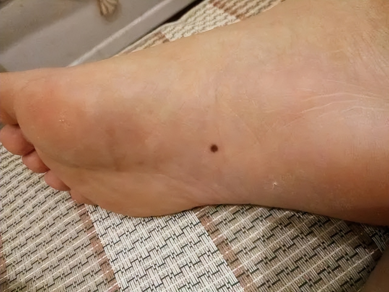 小孩痣长在什么地方代表什么,孩子身上的痣真的能预示未来