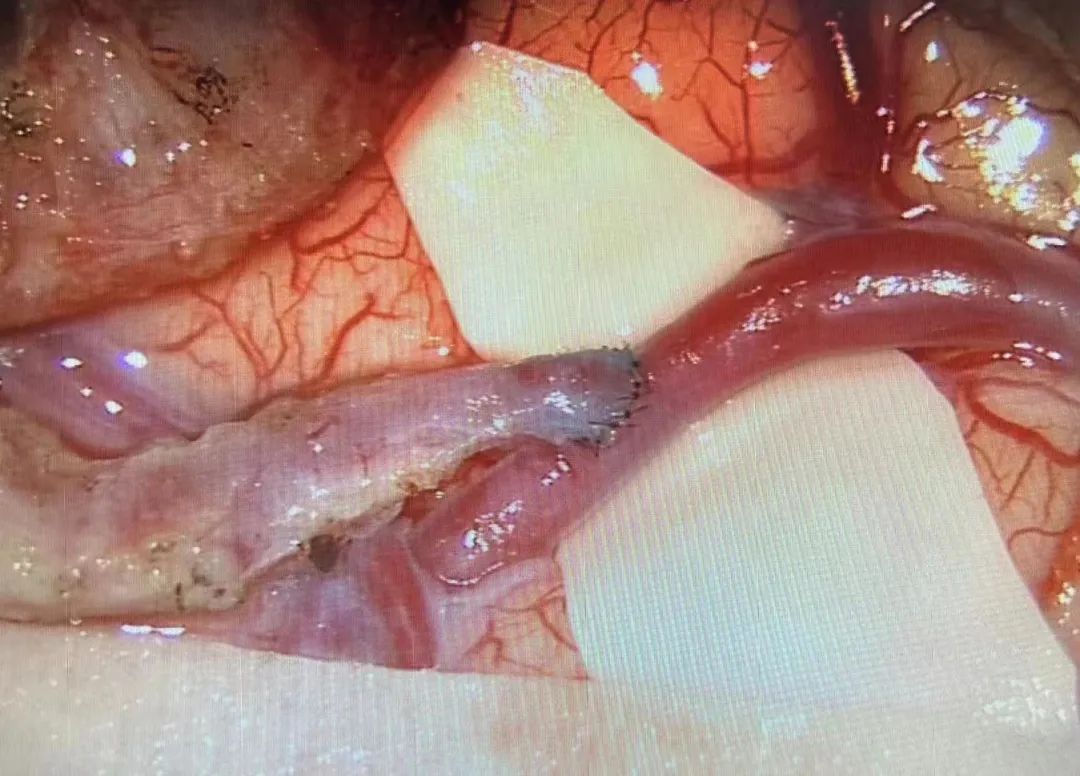 血管缝合200多针,脑血管搭桥手术2011年的成功率