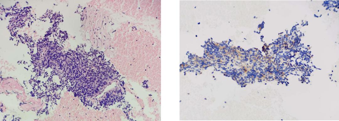 胸口肌肉酸痛皮疹,左肺上叶纵隔旁可见不规则团块影