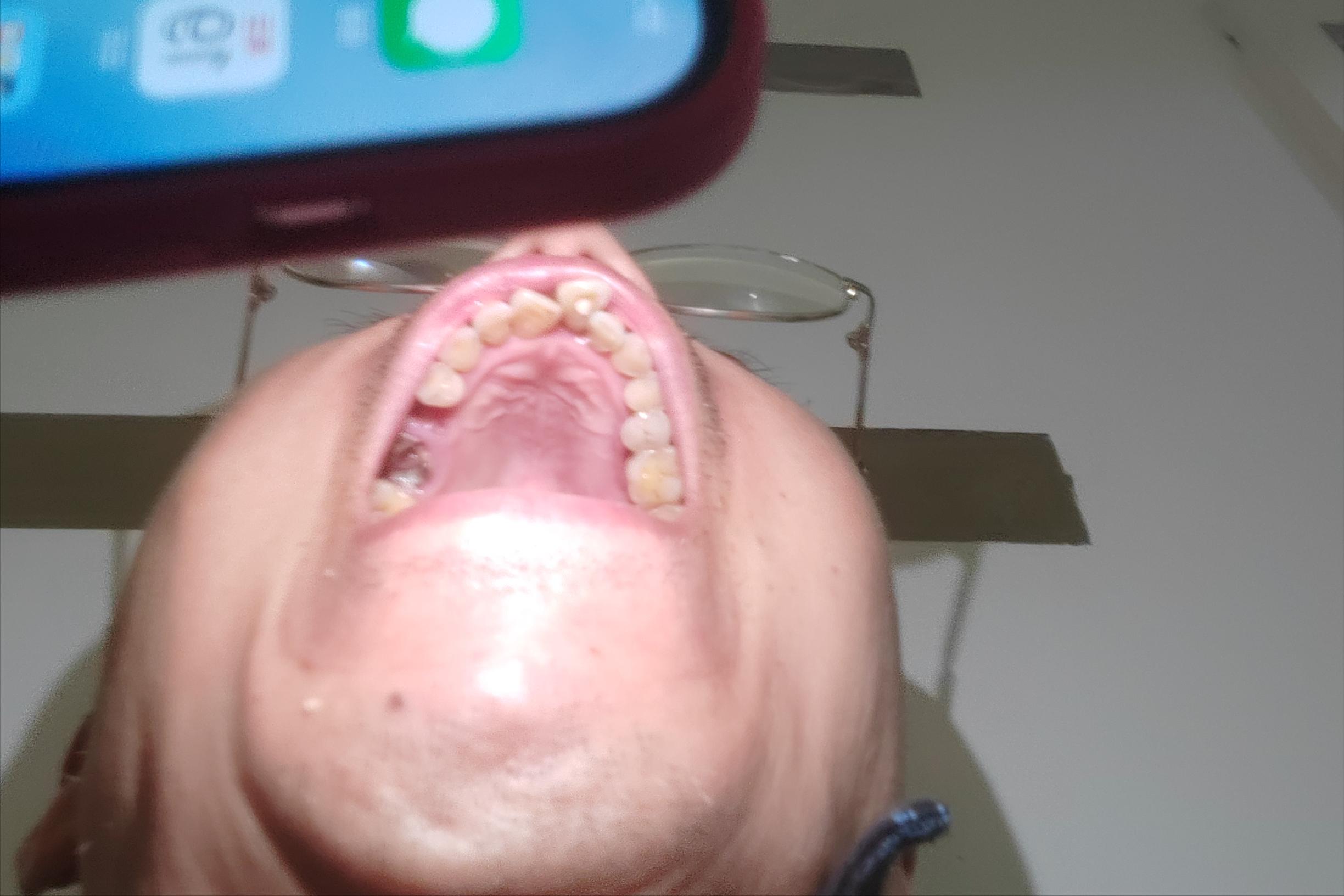 今天抽了牙髓之后还是疼,抽了牙神经后没有做根管