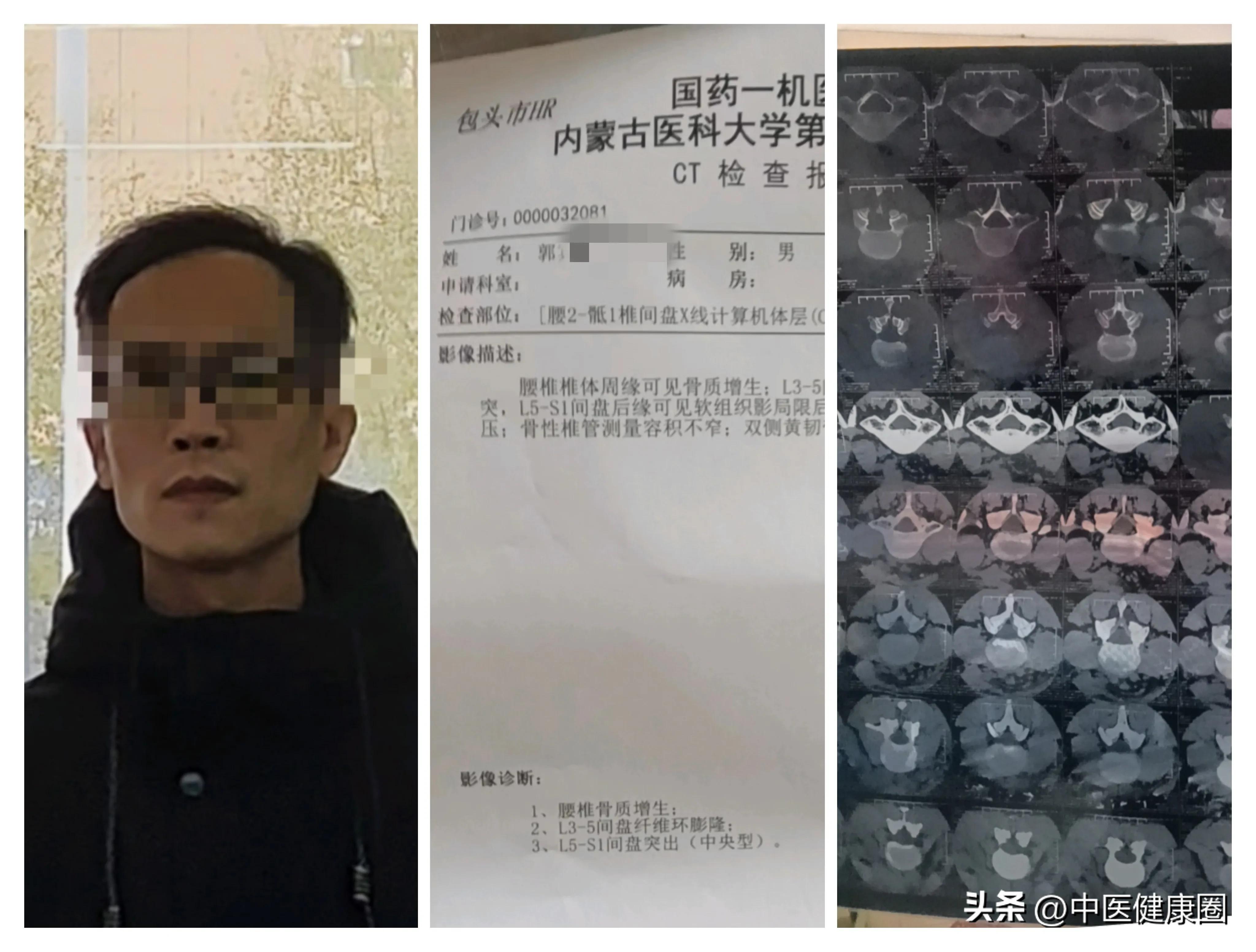 一个人治腰突绝密外敷秘方,治疗腰突特效方