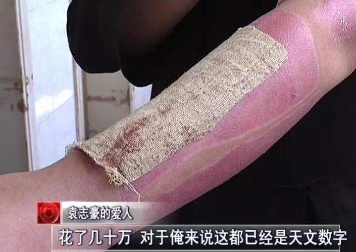 河南男子掉锅烫伤爸妈植皮救儿子,河南男子掉入油锅后续