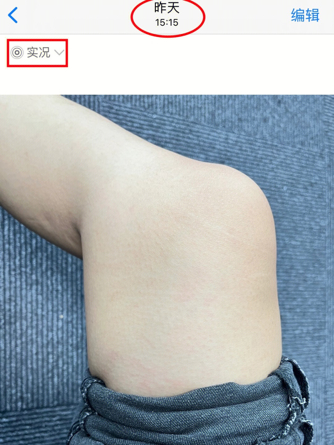 如何淡化腿上肥胖纹小窍门,腿上有肥胖纹怎么遮瑕