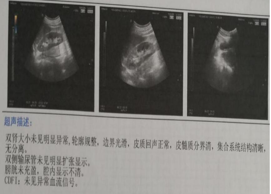 尿路感染导致急性肾盂肾炎,尿路感染高烧肾炎