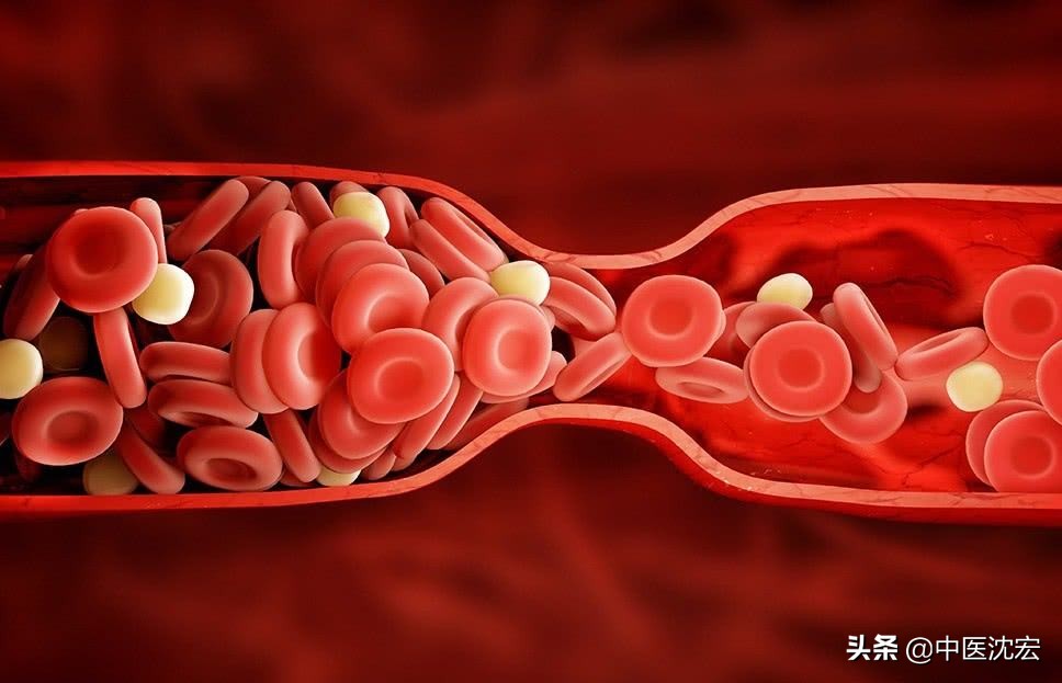 血为养命之源,血瘀体质易得心梗吗