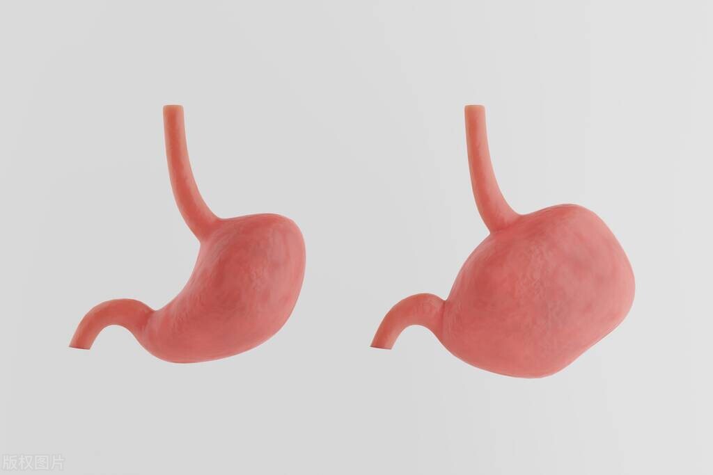 十二指肠切除手术后胃瘫能恢复吗,胃管引流治疗胃瘫