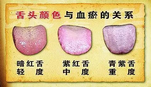 名医讲解桂枝茯苓丸,桂枝茯苓丸是去淤血最好的方子吗