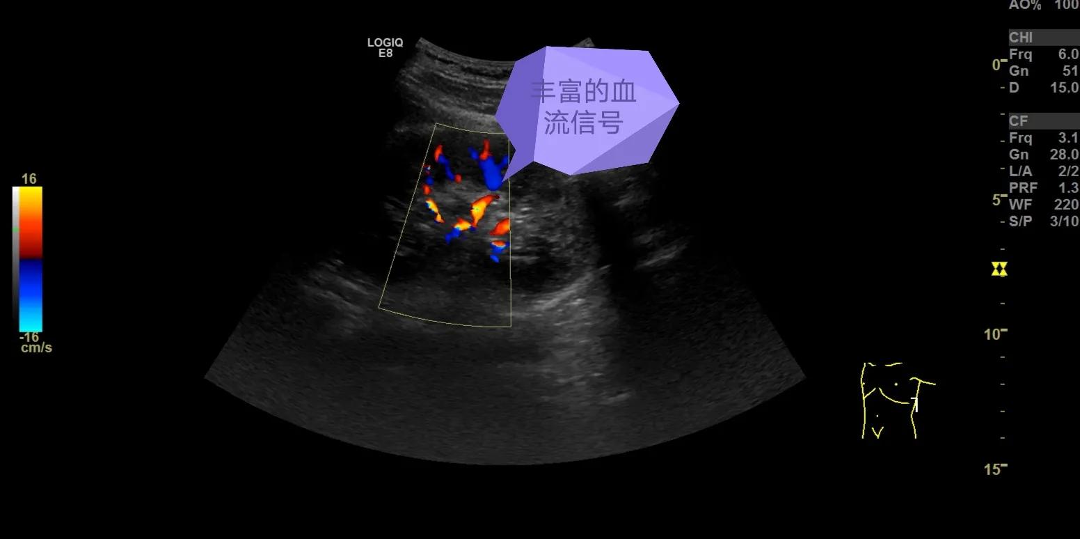 肾脏超声检查报告,肾脏彩超能查出慢性肾病吗
