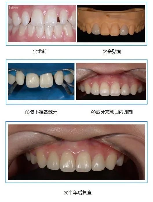 总塞牙怎么彻底解决,老是塞牙缝怎么修补最好
