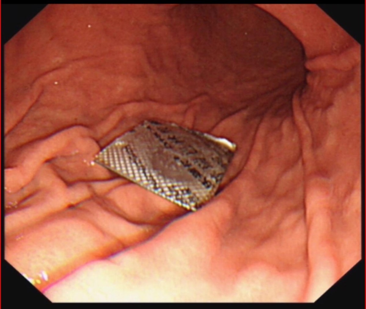 父亲误吃药,孩子误吞异物爸爸成功获救新闻