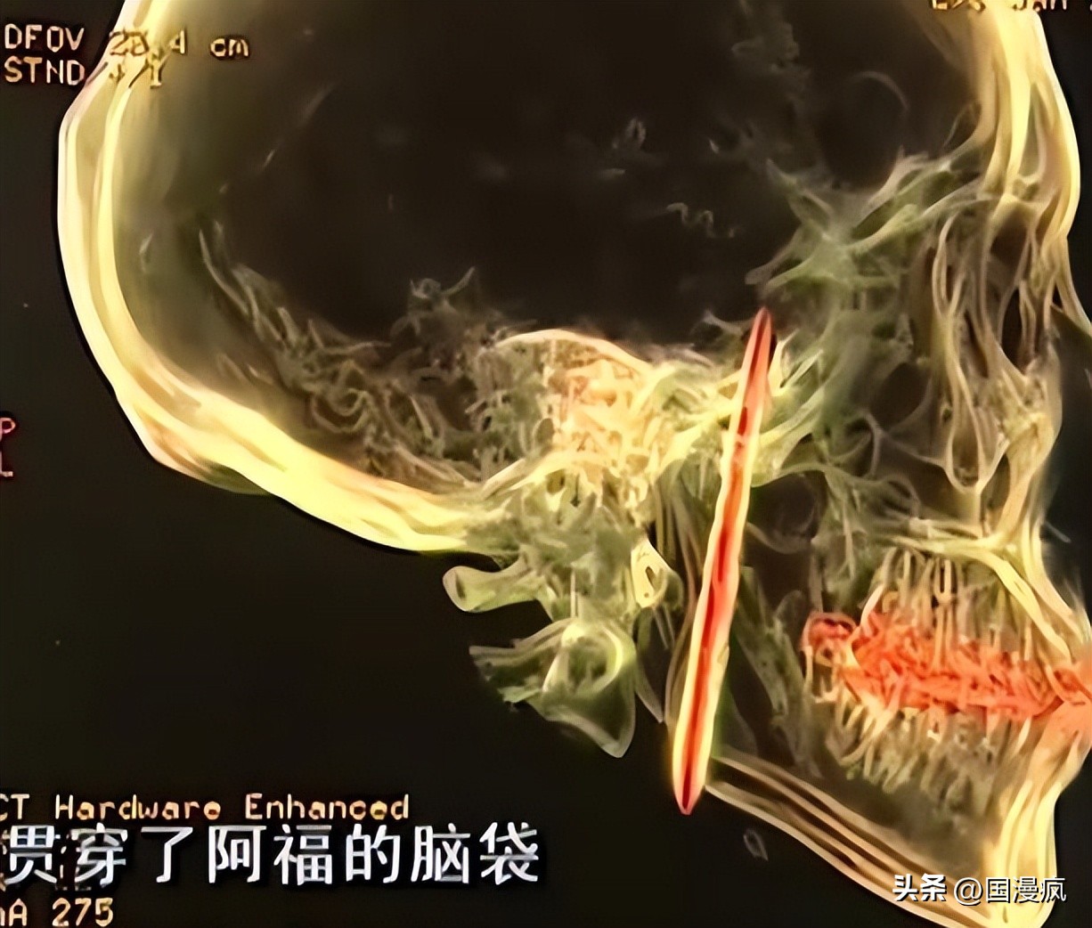 女子按压颈部致丈夫死亡获刑,女子按压颈部致丈夫死亡案疑点
