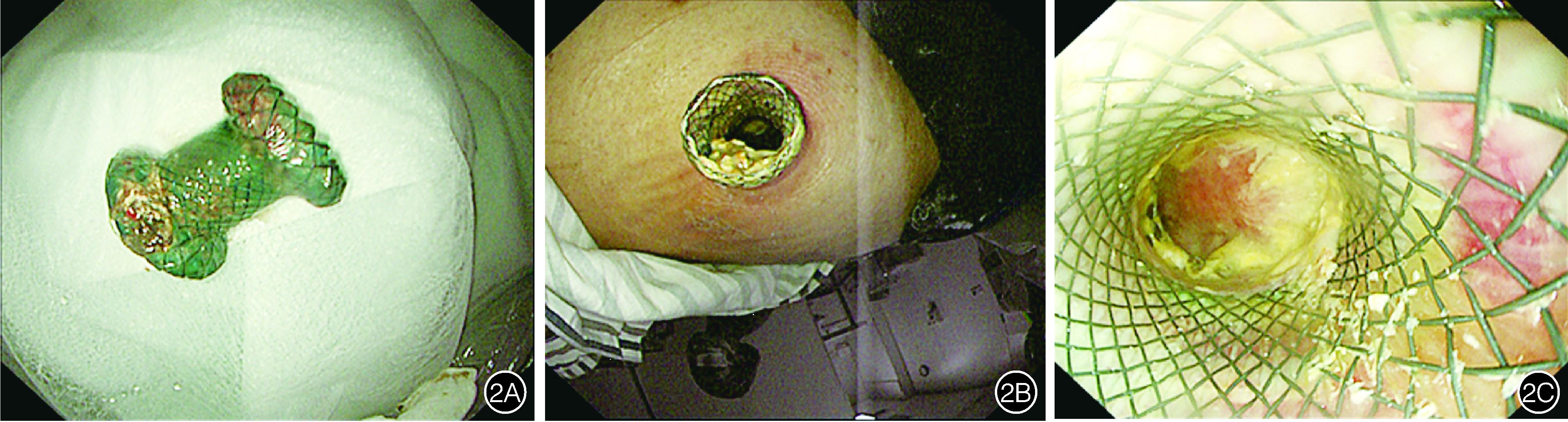 经皮肾镜治疗胰腺炎,内镜下胰腺坏死组织清创引流术