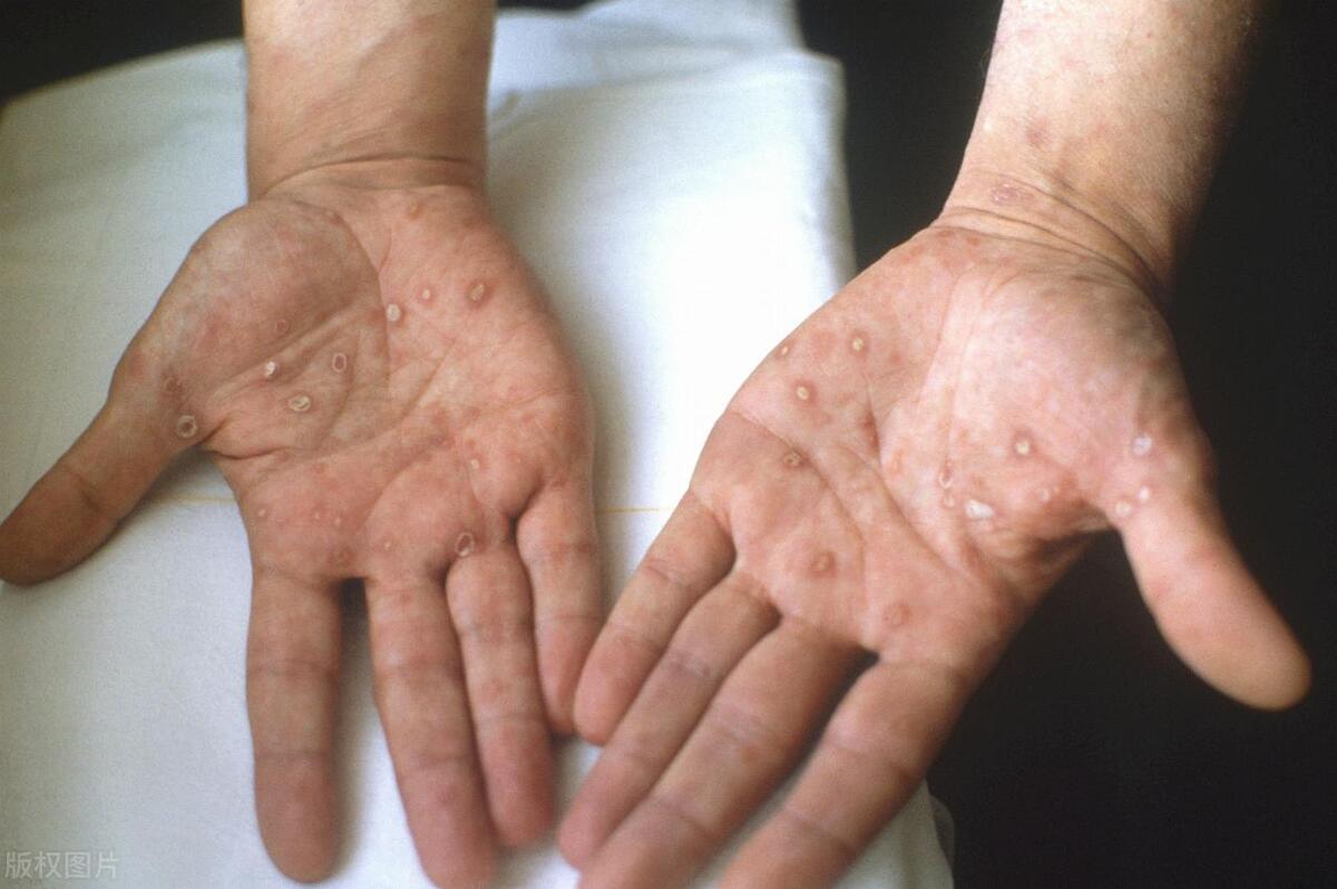 四种皮肤病要警惕,一摸皮肤就红的皮肤病