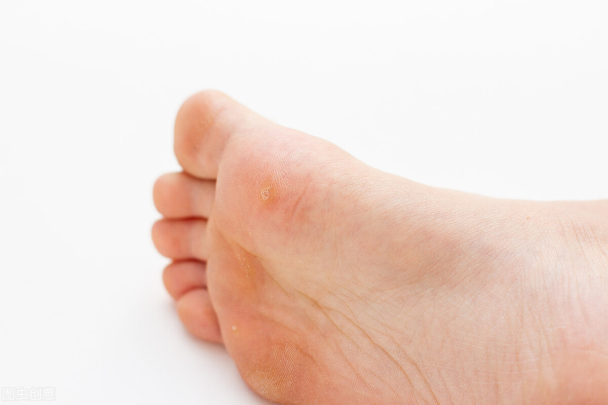 鸡眼和跖疣的区别该怎么治疗,鸡眼跖疣怎么去除最有效