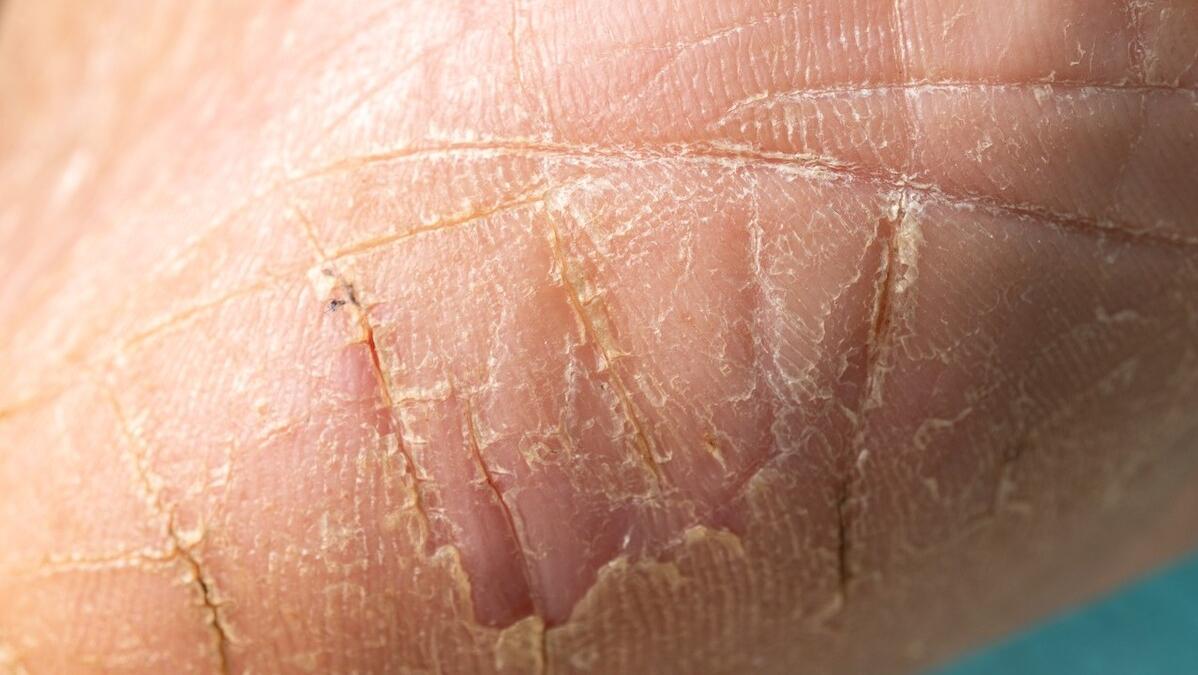 专业治疗灰指甲脚气甲沟炎,灰指甲脚趾甲沟炎用什么药