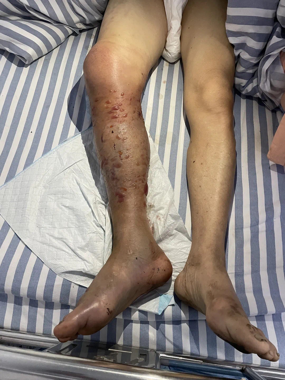 男子被五步蛇咬伤一刀斩断手指,男子被五步蛇咬后七孔流血