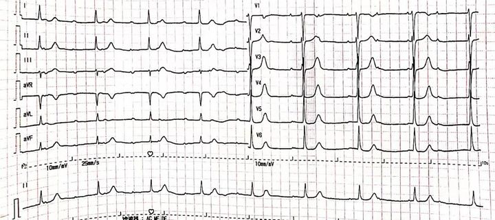 中耳炎引起耳朵越来越聋,小小的中耳炎为什么治不好