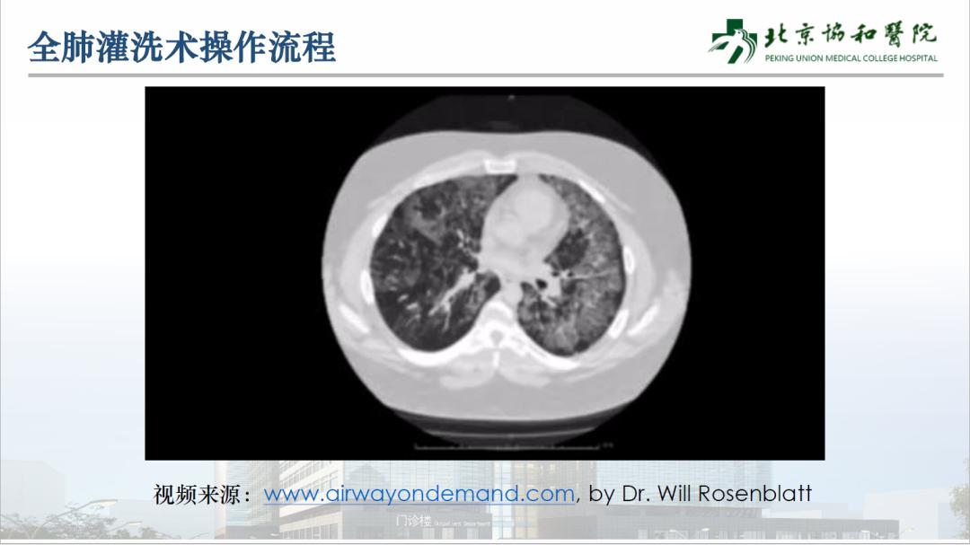 ecmo体外人工膜肺ppt,vv-ecmo怎么用