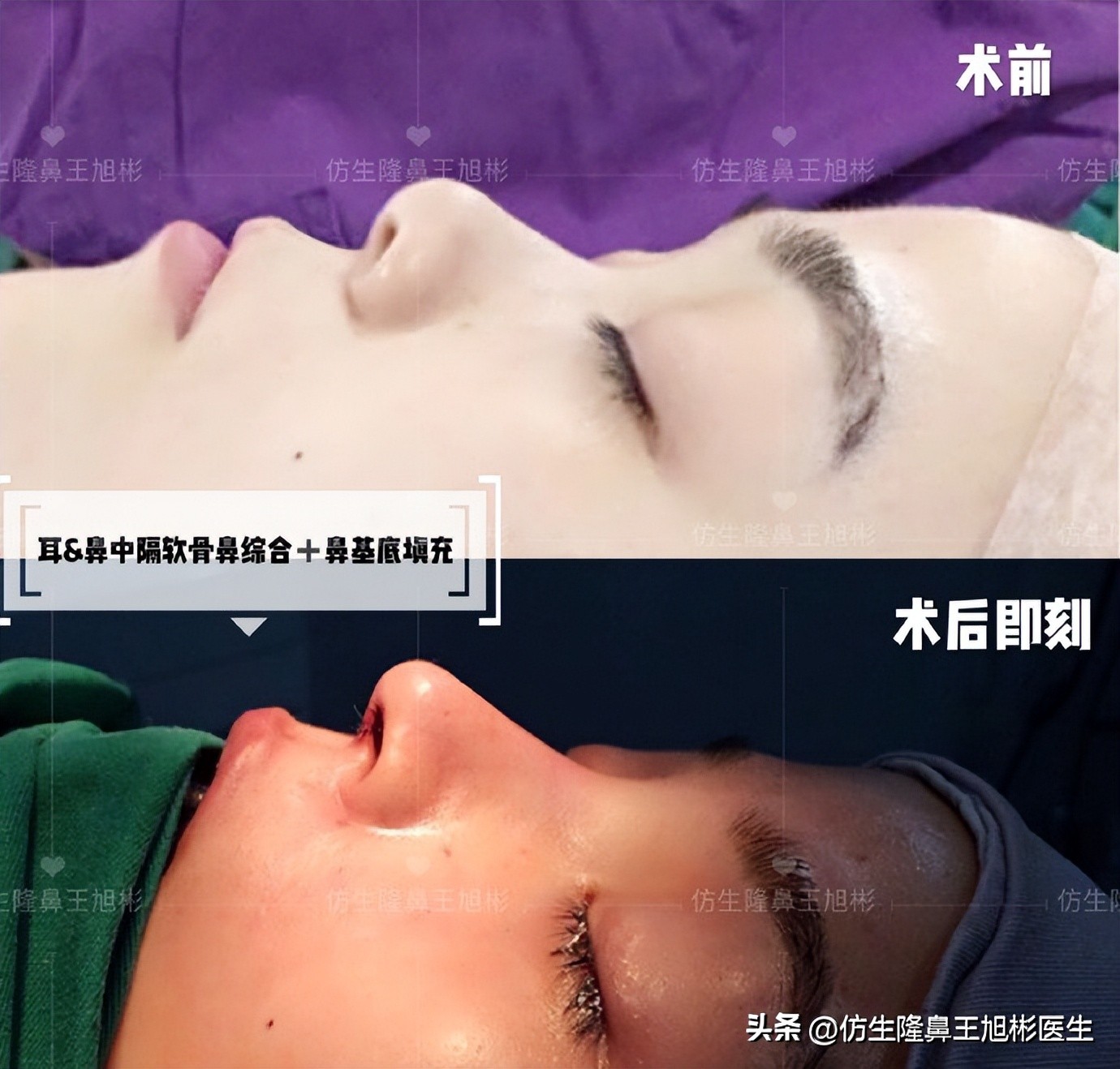 整形鼻部科普知识,隆鼻整形科普知识