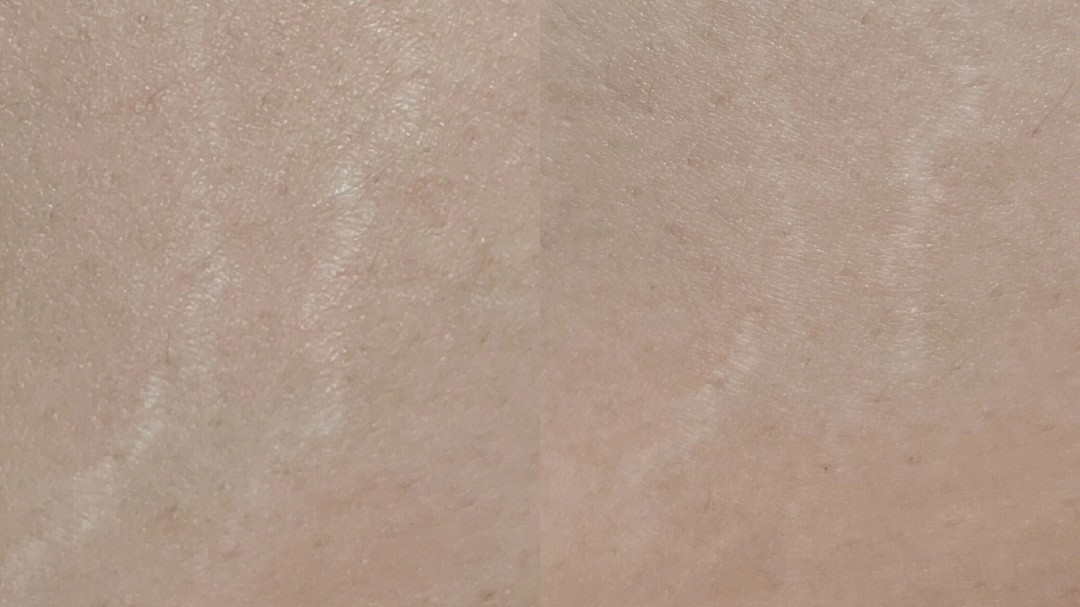 如何淡化腿上肥胖纹小窍门,腿上有肥胖纹怎么遮瑕