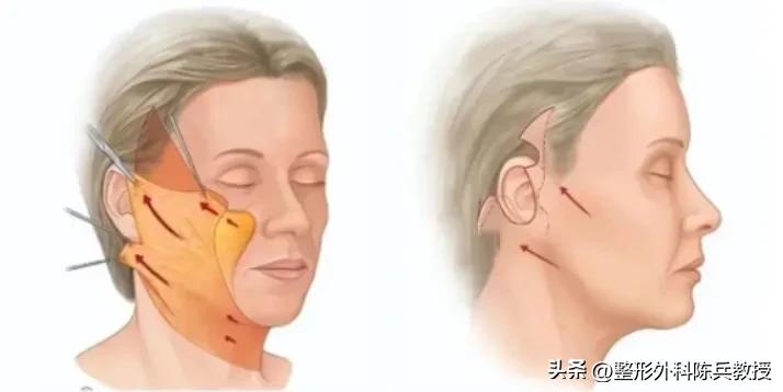 抗衰大拉皮,拉皮作为面部抗衰项目要注意哪些