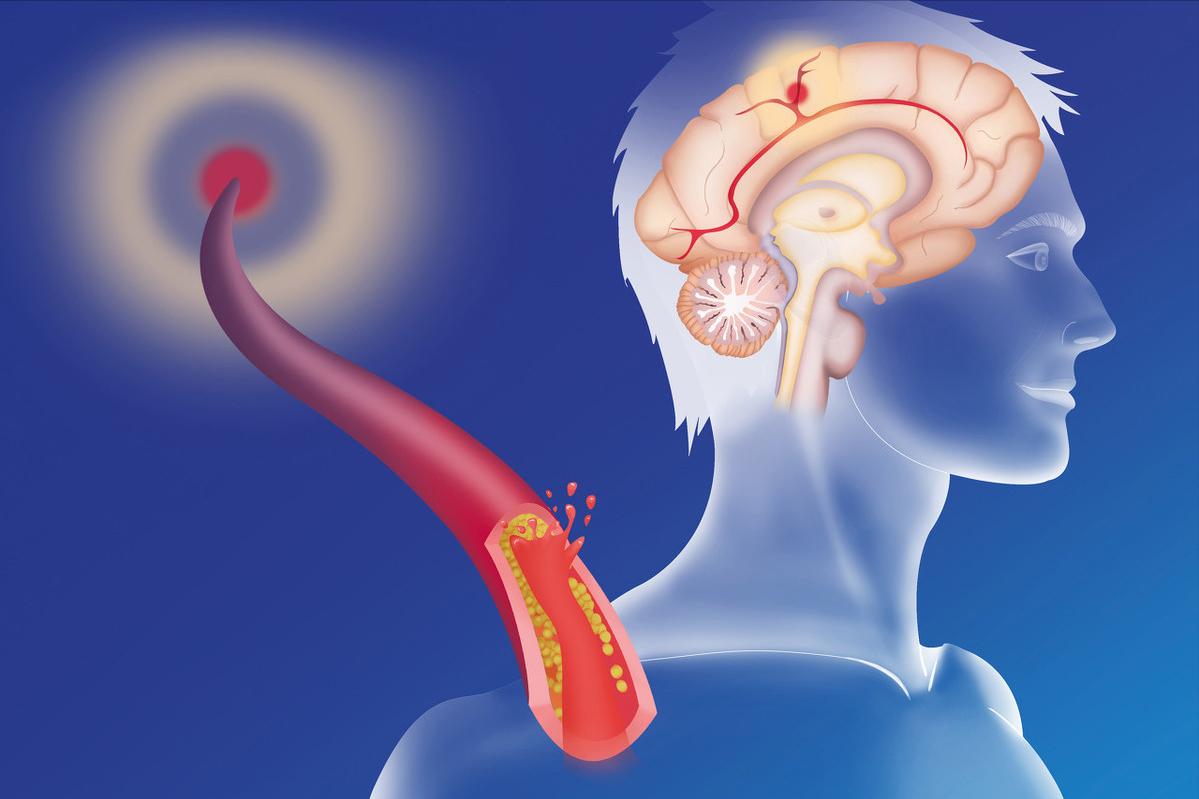 甲钴胺治疗腰椎间盘突出吃几片 (甲钴胺片治疗腰椎间盘突出吃多久)