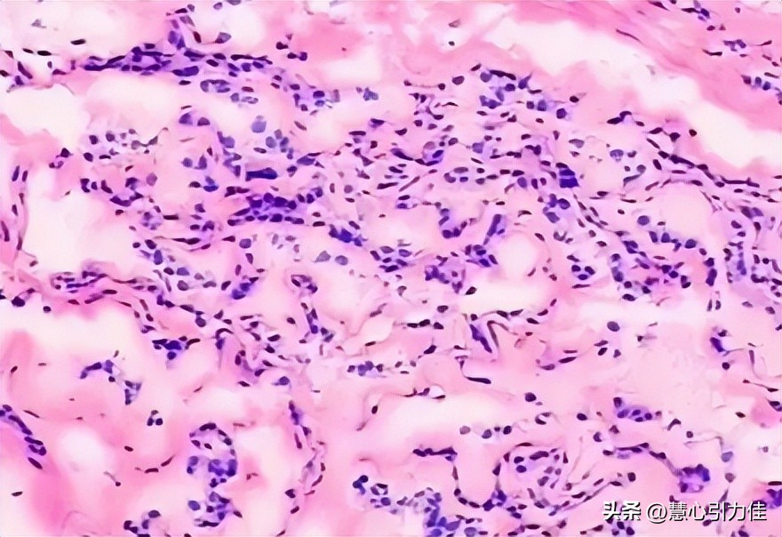制样方法对IF钢透射电镜复型样品分析,样品的表面光洁度有何变化