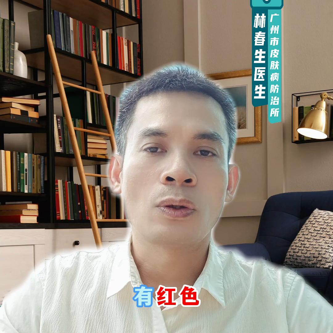 黑色素瘤是一个痣还是很多痣,黑色素瘤和普通的痣有什么区别