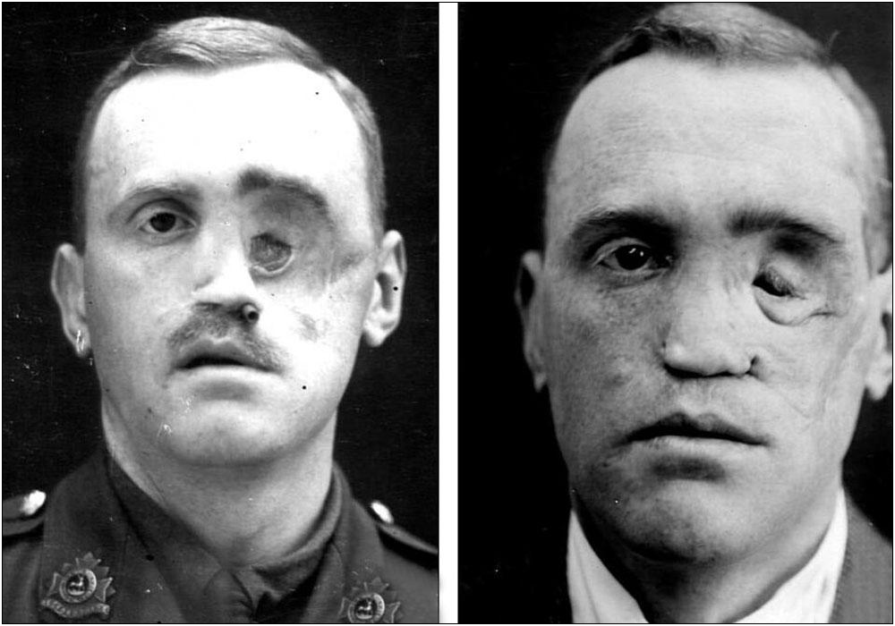 空姐注射玻尿酸打进血管险丧命,一空姐注射玻尿酸险丧命