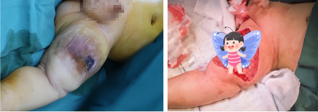 婴儿脑动脉瘤破裂开颅手术成功率,宝宝身上的血管瘤终于手术成功