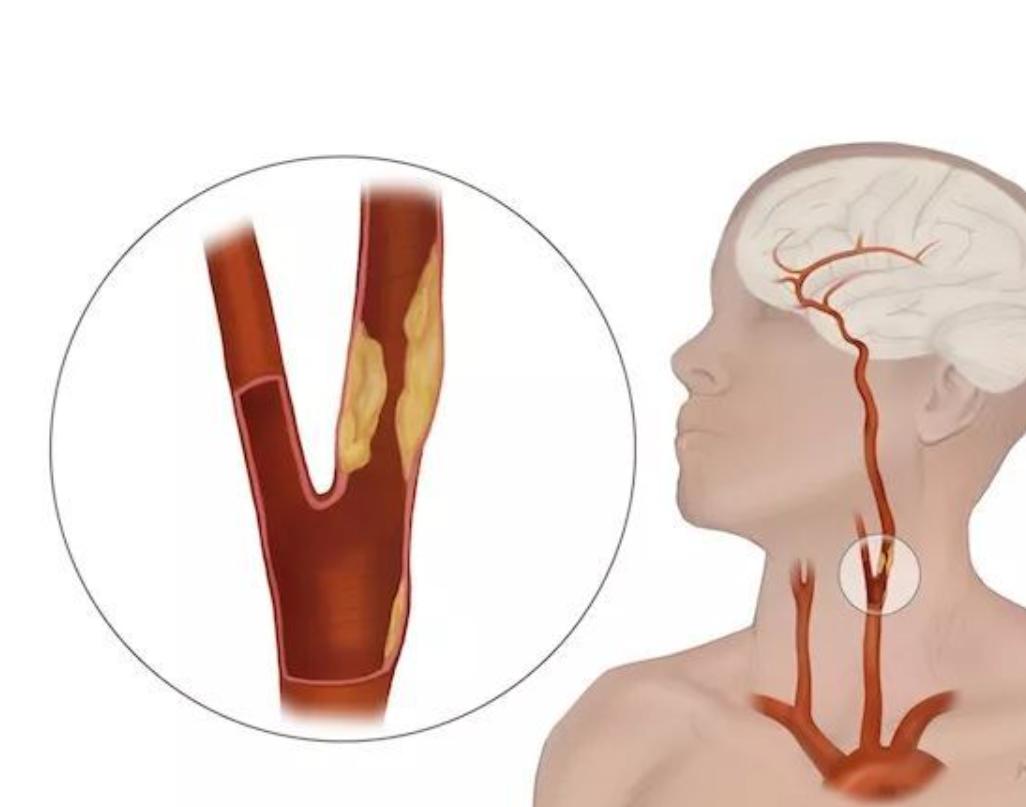 颈动脉硬化有斑块要吃阿司匹林吗,发现颈动脉斑块必须吃药吗