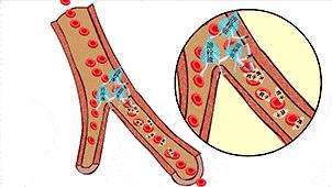 突发急性心梗做支架,急性心梗溶栓后还需要支架治疗吗