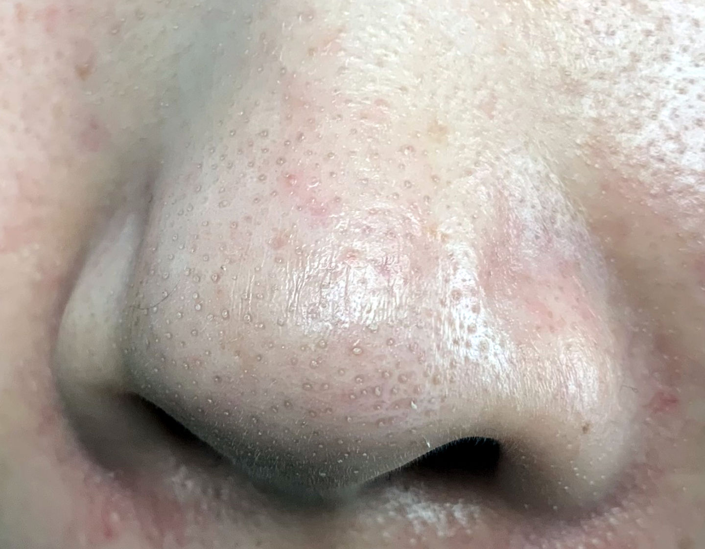 真黑头假黑头傻傻分不清楚，怎么去黑头？