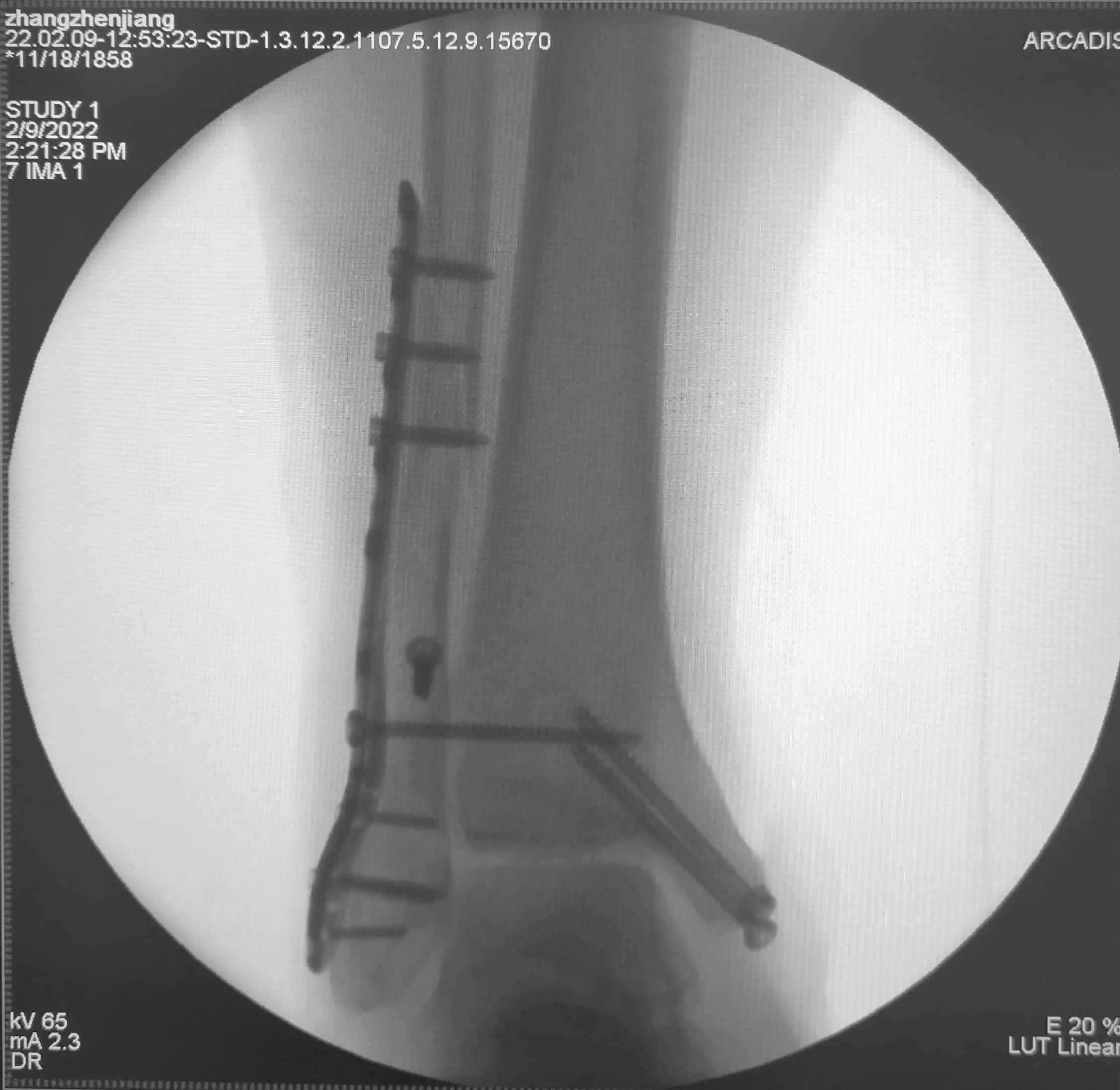 咋就不能先复一下位呢？手法复位就那么难吗？