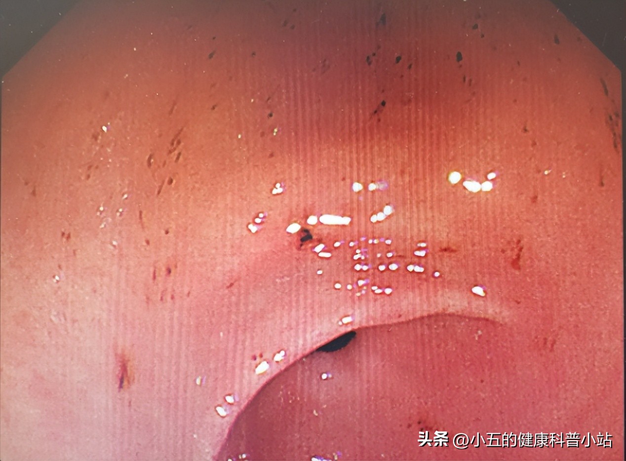 奥美拉唑治胃溃疡最多连续吃几天,奥美拉唑治疗胃溃疡需要多久