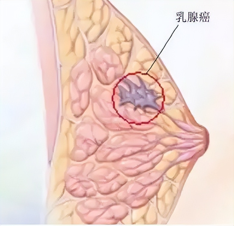 雌激素和孕激素对乳腺癌作用,雌激素和孕激素对乳腺癌的影响