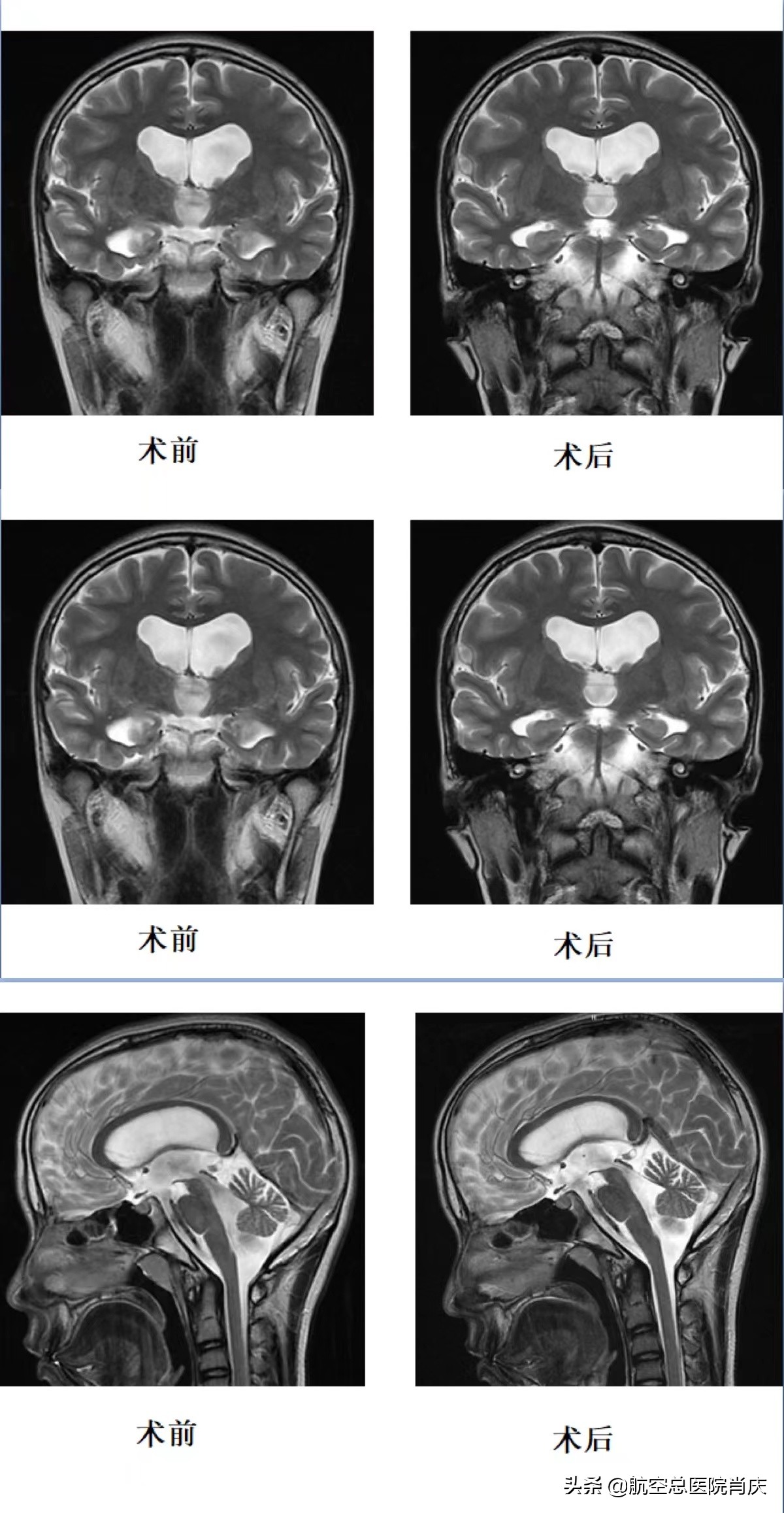 软性神经内镜助少年解除病痛，开启人生新篇章