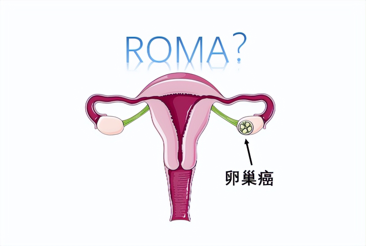 卵巢癌发出的警报有哪些,卵巢癌的早期信号会有哪些