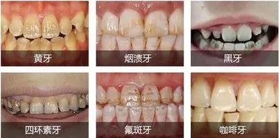 全瓷牙和烤瓷牙相比哪个更结实,全瓷牙和烤瓷牙哪个质量好一点