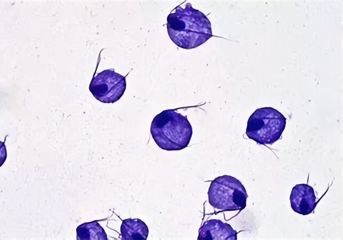 阴道炎支原体感染的症状表现,细菌性阴道炎与支原体感染